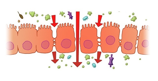 Дырявый кишечник: симптомы, причины и лечение