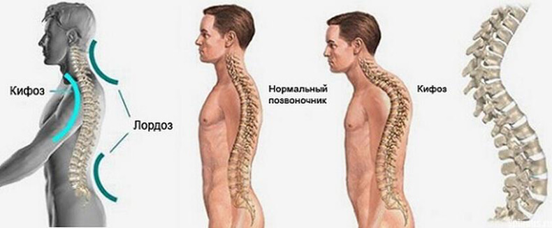 Чрезмерный грудной кифоз: гораздо больше, чем плохая осанка