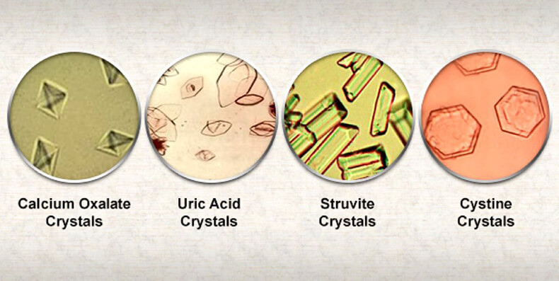  5 шагов для предупреждения камнеобразования в почках