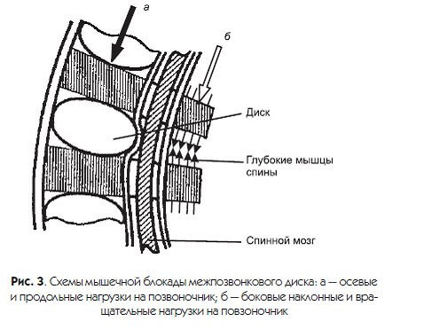 Как избежать заболеваний позвоночника: 2 рекомендации по профилактике мышечных блокад дисков
