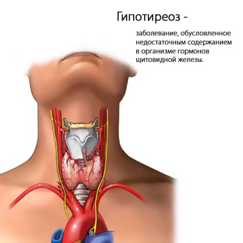 Истинный гипотиреоз и соматические заболевания