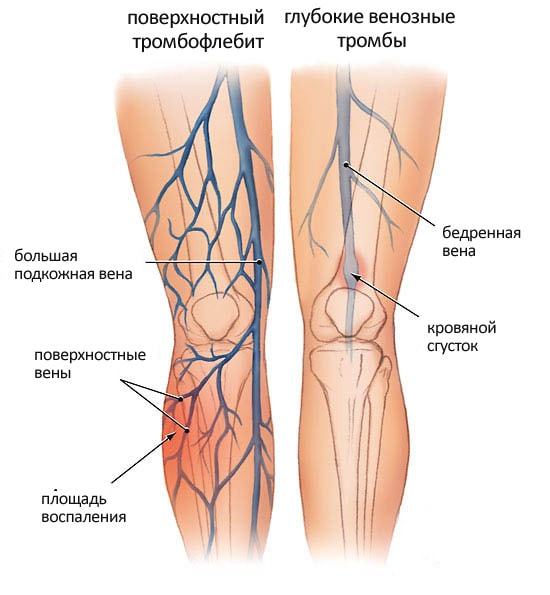 Как избежать операции при тромбофлебите 