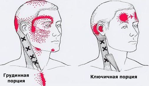 Карта триггеров: точки боли и точки напряжения мышц 