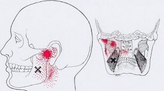 Карта триггеров: точки боли и точки напряжения мышц 
