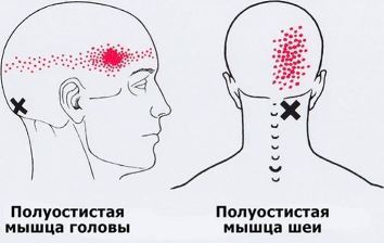 Карта триггеров: точки боли и точки напряжения мышц 