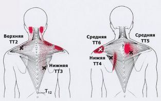 Карта триггеров: точки боли и точки напряжения мышц 