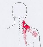 Карта триггеров: точки боли и точки напряжения мышц 