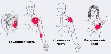 Карта триггеров: точки боли и точки напряжения мышц 