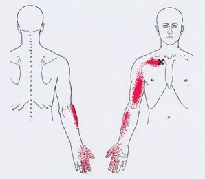 Карта триггеров: точки боли и точки напряжения мышц 