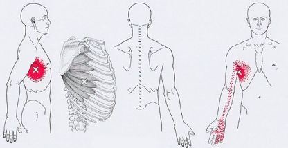 Карта триггеров: точки боли и точки напряжения мышц 