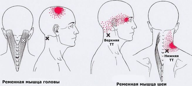 Карта триггеров: точки боли и точки напряжения мышц 