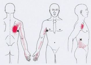 Карта триггеров: точки боли и точки напряжения мышц 