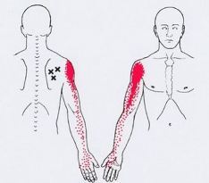 Карта триггеров: точки боли и точки напряжения мышц 