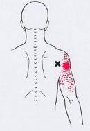 Карта триггеров: точки боли и точки напряжения мышц 