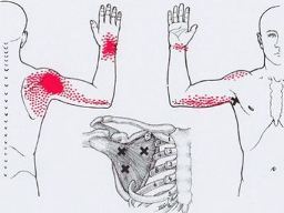 Карта триггеров: точки боли и точки напряжения мышц 