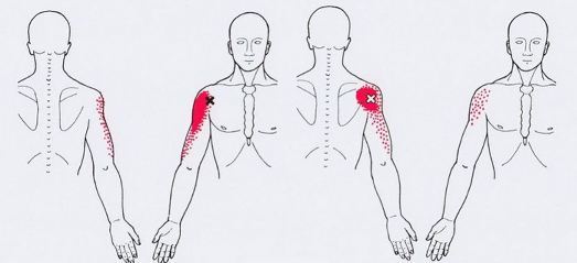 Карта триггеров: точки боли и точки напряжения мышц 