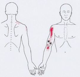 Карта триггеров: точки боли и точки напряжения мышц 