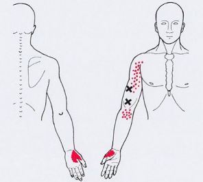 Карта триггеров: точки боли и точки напряжения мышц 