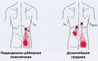 Карта триггеров: точки боли и точки напряжения мышц 