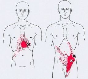 Карта триггеров: точки боли и точки напряжения мышц 