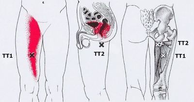 Карта триггеров: точки боли и точки напряжения мышц 