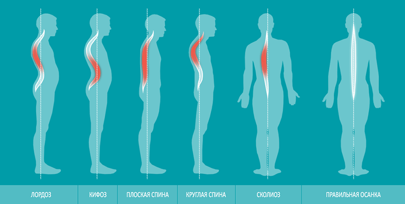 Поясничный лордоз: Как распознать и ЧТо делать