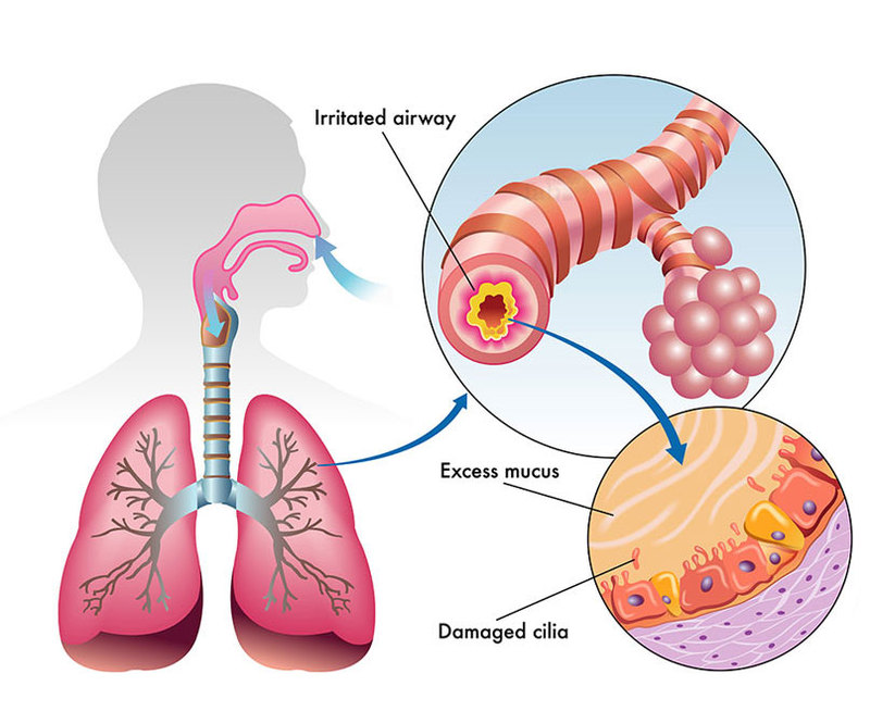  Как избавиться от самого застарелого кашля, не поддающегося медикаментозному лечению