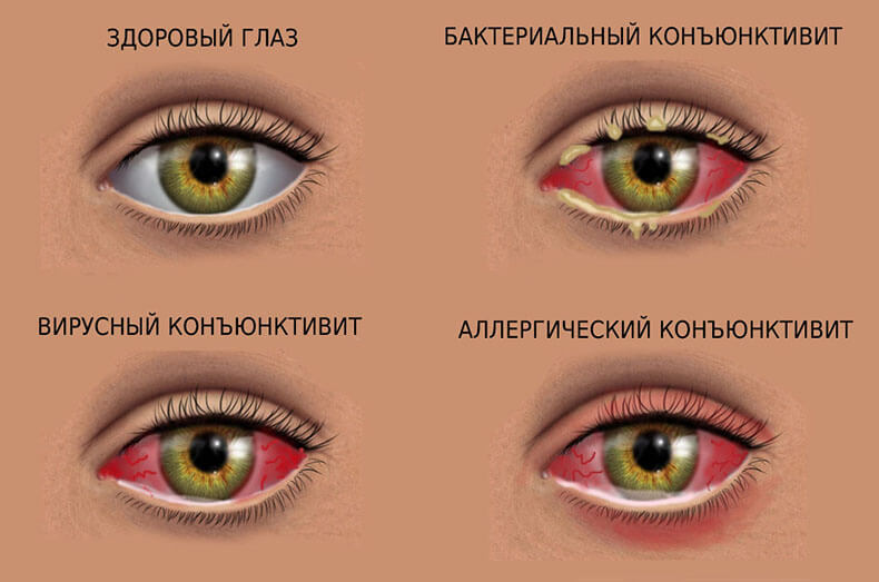 Коньюктивит: эффективное лечение натуральными средствами