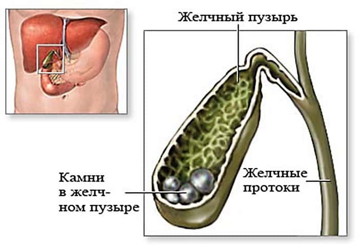 Желчные люди: 5 болезней, которые могут прятаться в желчном пузыре