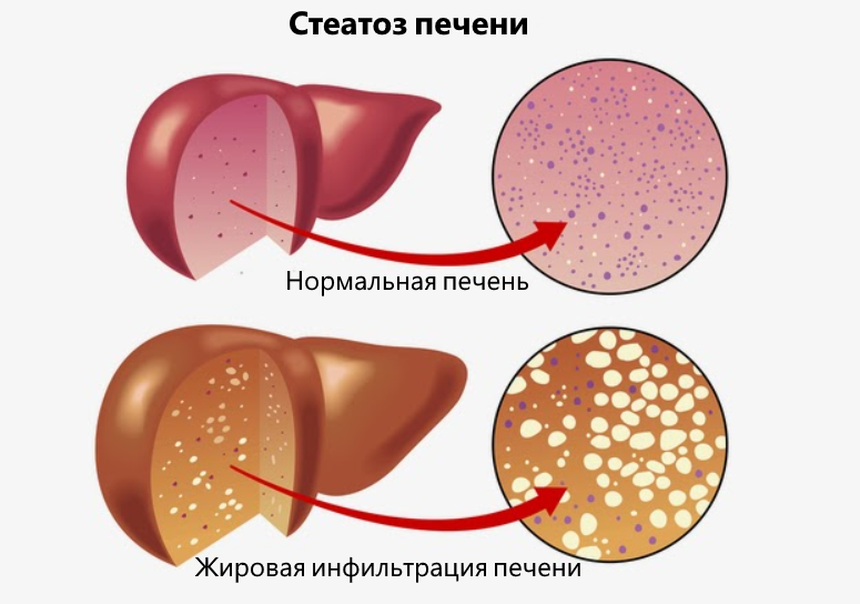 Жировая болезнь печени: 6 предупреждающих сигналов!