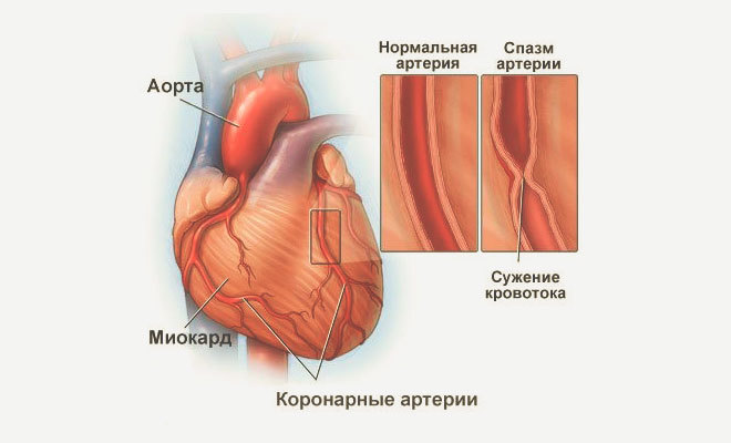 «Грудная жаба»: Как маскируются сердечные проблемы