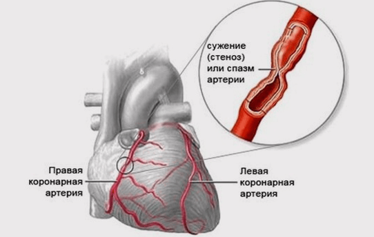 «Грудная жаба»: Как маскируются сердечные проблемы