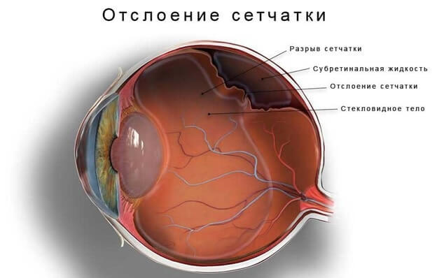 Отслойка сетчатки: что важно знать