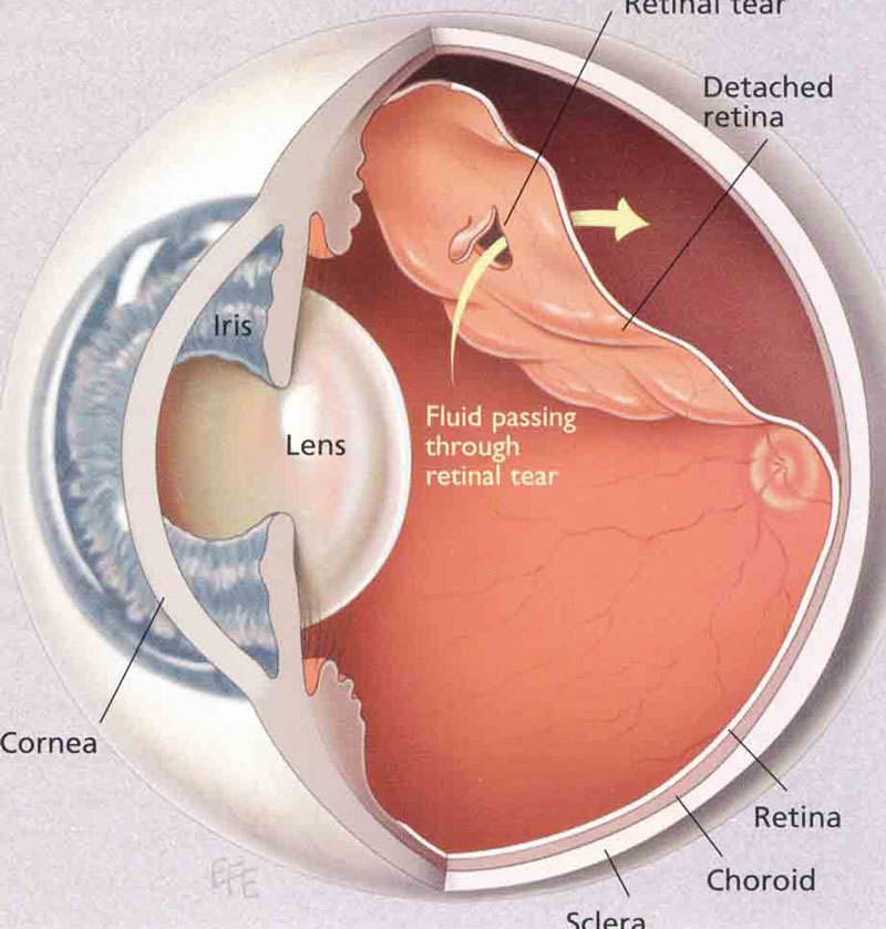 Отслойка сетчатки: что важно знать