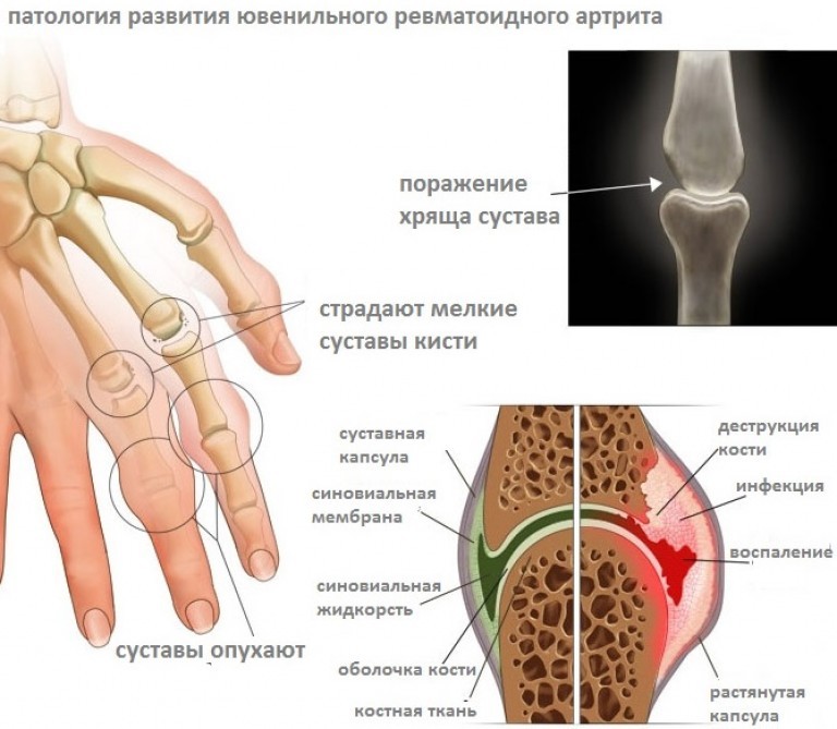 Упражнения при артрозе рук, которые принесут облегчение