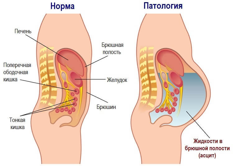 Водянка: Почему в теле скапливается лишняя вода и как ее вывести