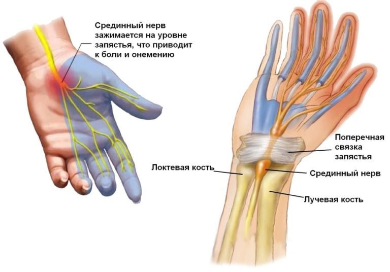 Туннельный синдром: 5 натуральных решений для уменьшения боли