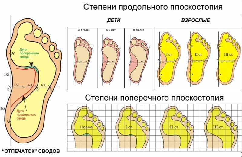 Как определить плоскостопие в домашних условиях