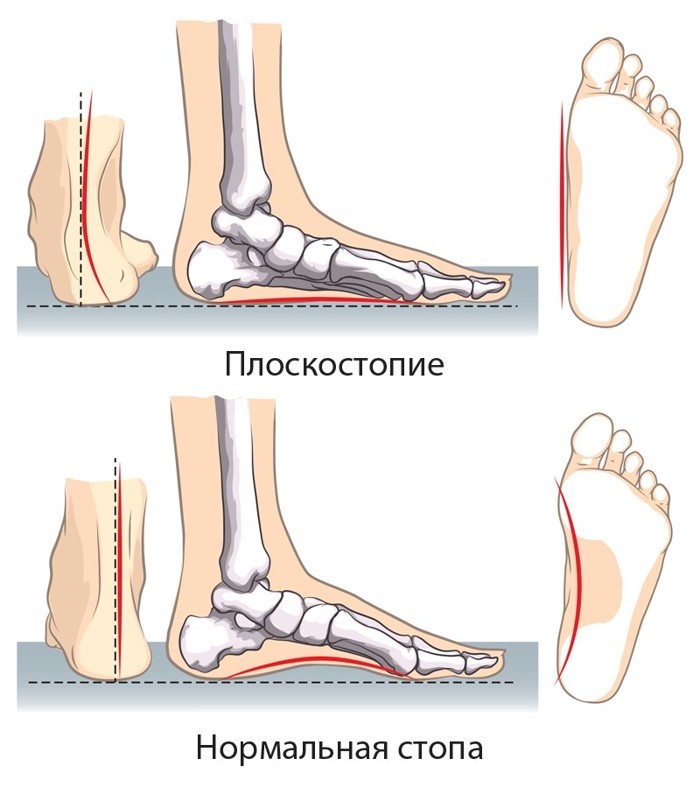 Как определить плоскостопие в домашних условиях