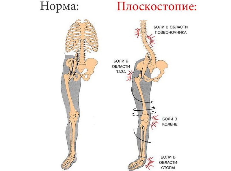 Как определить плоскостопие в домашних условиях