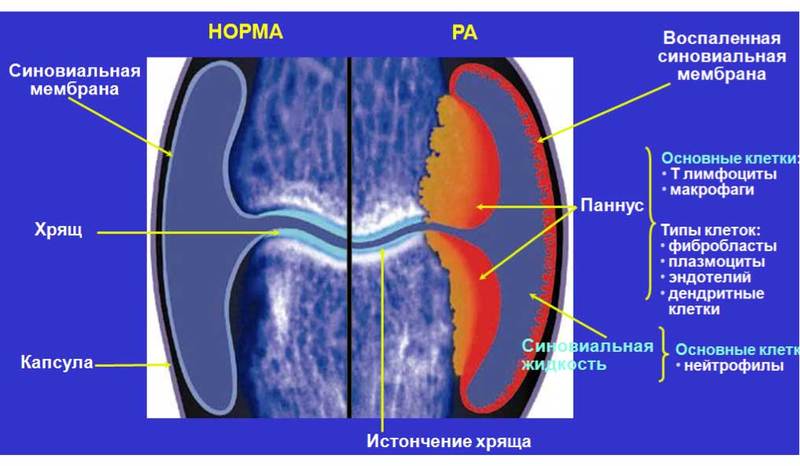 Как перевести РЕВМАТОИДНЫЙ артрит в стадию ремиссии