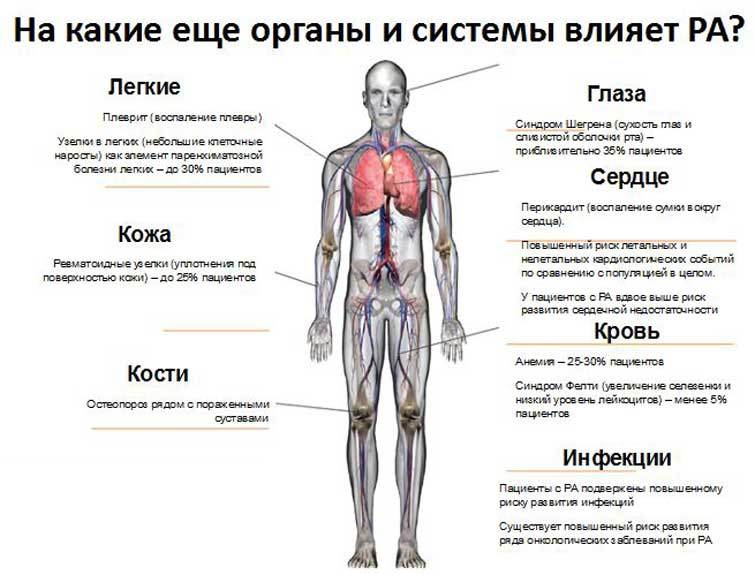 Как перевести РЕВМАТОИДНЫЙ артрит в стадию ремиссии