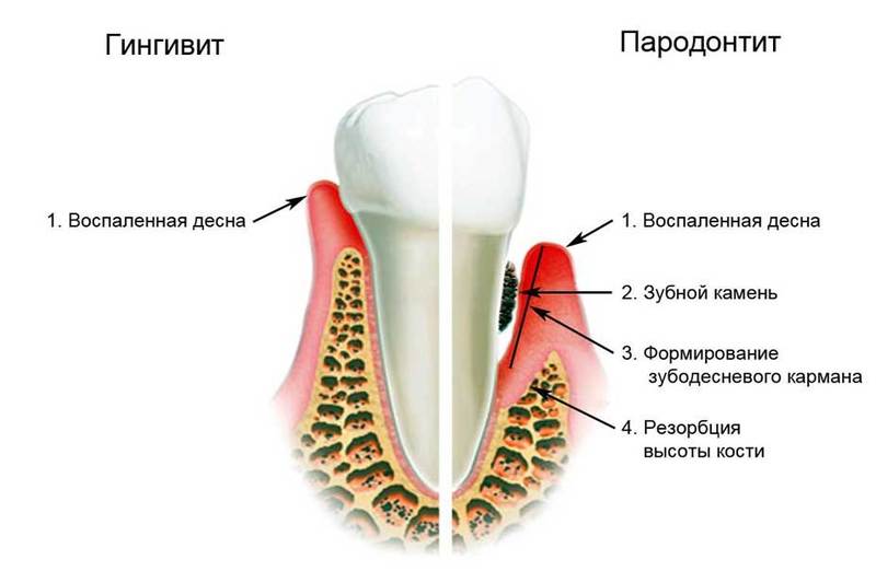 Воспаление дёсен и ревматоидный артрит: в чем СВЯЗЬ