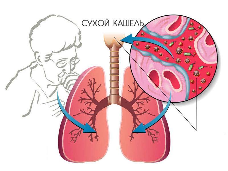 Как БЫСТРО избавиться от кашля: эффективный РЕЦЕПТ