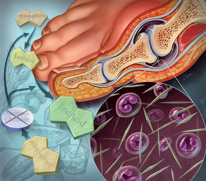 Окаменеть заживо: Подагрический артрит 
