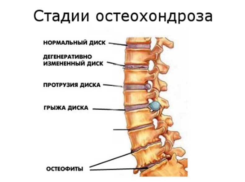 3 ДЕЙСТВЕННЫХ метода лечения ШЕЙНОГО остеохондроза у женщин