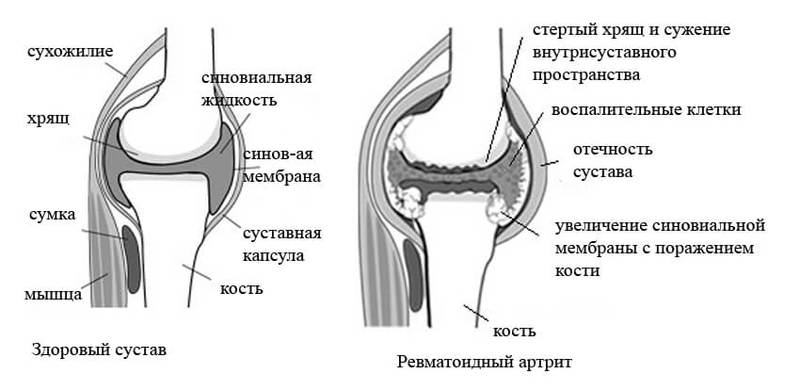 ПСИХОСОМАТИКА: ревматоидный и реактивный АРТРИТ