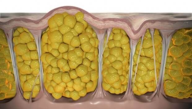 Гид по целлюлиту: почему он появляется и что с этим делать