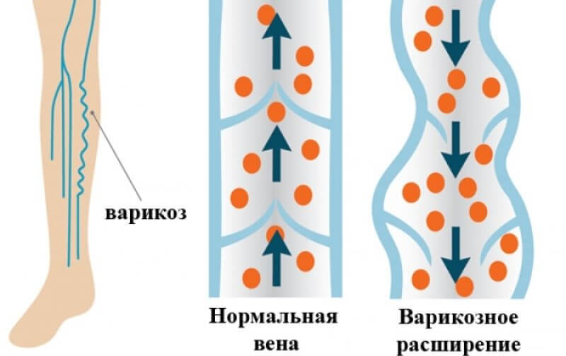 Гид по целлюлиту: почему он появляется и что с этим делать