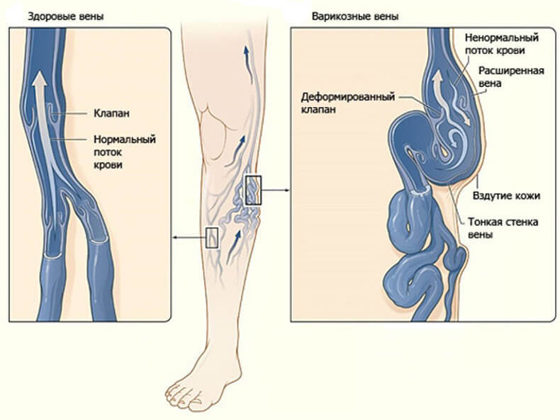 8 упражнений против варикоза